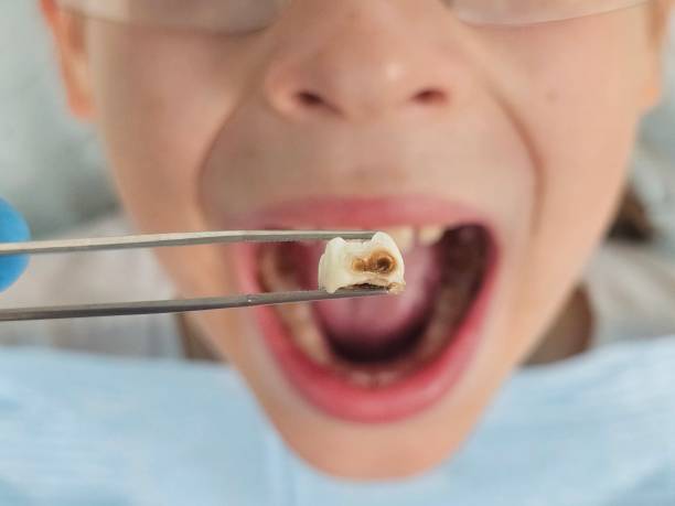 Best Affordable Emergency Dental Care  in Ferndale, WA