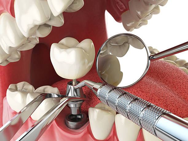 Best Dentist for Tooth Abscess  in Ferndale, WA